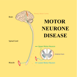 motor neurone disease 