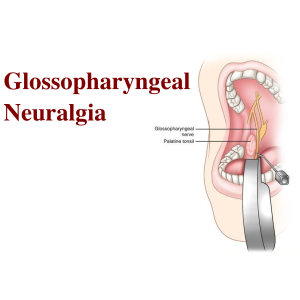  Glossopharyngeal Neuralgia