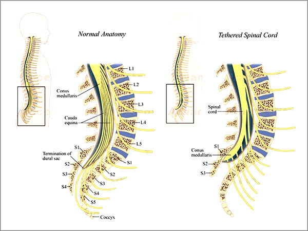 Tethered Cord Syndrome Dr Sai Sudarsan A Top Neurosurgeon In Ranchi